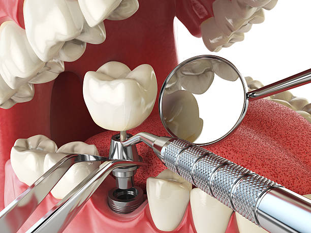 Best Emergency Dental Care for Broken or Chipped Teeth in Gillett, WI
